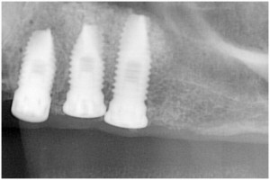 杉山5　左上56サイナスリフト後約3ヶ月